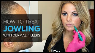 FAQ Bay Area Expert Shows How to Treat Jowls with Dermal Fillers [upl. by Pickford613]