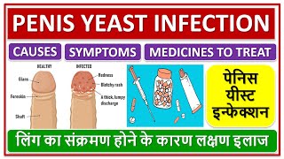 PENIS YEAST INFECTION CAUSES TREATMENT MEDICINE पेनिस यीस्ट इन्फेक्शन होने के कारण लक्षण इलाज [upl. by Mathilde]