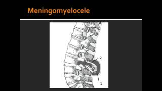 Spina Bifida Occulata Meningocele amp Meningomyelocele [upl. by Ribal]