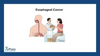 Esophageal Cancer [upl. by Xena]