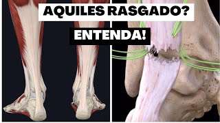 Aquiles rasgado Entenda [upl. by O'Rourke]