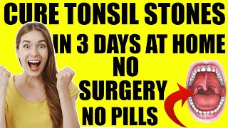 Tonsil Stones Treatment Removal At Home  Get Rid Of Tonsil Stones In JUST 3 Days FOREVER [upl. by Lindsy]