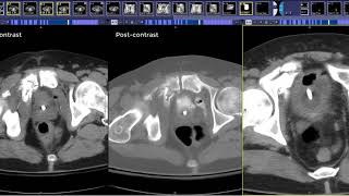 How to read a CT Cystogram [upl. by Seravat]