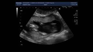 Ultrasound Video showing Pregnancy of about 18 weeks with Anencephaly [upl. by Aisiat436]