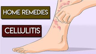 Home Remedies for Cellulitis Skin Infection [upl. by Dopp]