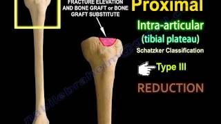 Tibial Plateau Fracture Fixation Proximal Tibia  Everything You Need To Know  Dr Nabil Ebraheim [upl. by Ailliw]