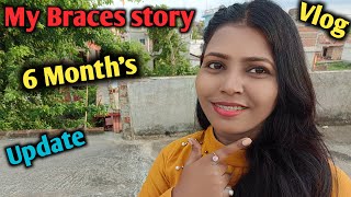 My Braces Journey 😊 My Braces Story 6 Months Update amp Braces Type ND Family Vlogs [upl. by Zora]