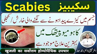 Scabies شدید خارش اور کھجلی शरीर में कीड़ों से खुजली होना Homeopathic Treatment In Urdu  Hindi [upl. by Benia]