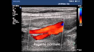 Corsi di ecocolordoppler dei TSA Tronchi Sovra Aortici [upl. by Fattal]