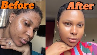 How I cleared my acne using 2 products My acne journey [upl. by Nordin494]