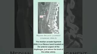 Median arcuate ligament syndrome  MALS [upl. by Nnawtna]