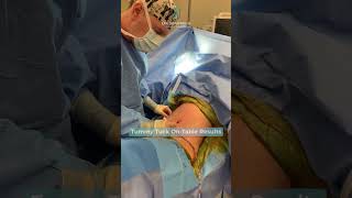 Tummy Tuck Transformation A Petite Moms Journey to a Flat Abdomen tummytucksurgery [upl. by Yekcin40]