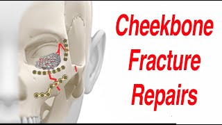 Tripod amp Other Cheekbone Facial Fractures [upl. by Yruy]