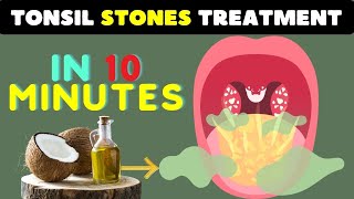 How to Remove Tonsil Stones 10 Powerful Home Remedies for Tonsil Stones Relief [upl. by Loriner775]