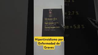 Gammagrafía de tiroides en hipertiroidismo por enfermedad de Graves [upl. by Guimar586]