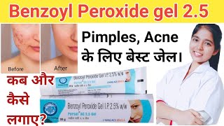 Persol AC 25 GEL  Pimple Acne ka ilaj  Benzoyl peroxide gel  DrxPranjali Satpute [upl. by Aiduan476]