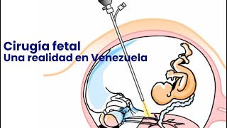 Cirugía fetal Una realidad en Venezuela [upl. by Liebman266]