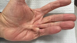 Dupuytrens Contracture in 2 minutes Symptoms Causes Treatment [upl. by Ellicott949]