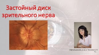 Застойный диск зрительного нерва Причины классификация дифференциальный диагноз [upl. by Esoj911]