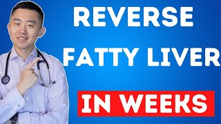 The FASTEST Way to Reverse Fatty Liver Naturally  NAFLD Treatment [upl. by Irotal754]