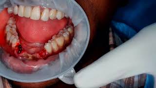 lower front teeth replacement with single piece Bcs Ex  compressive implant [upl. by Nylidam]