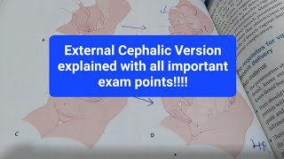 External Cephalic Version ECV in HINDI made easy [upl. by Tergram]