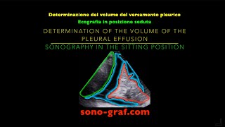 Ecografia  Determinazione del volume del versamento pleurico [upl. by Osgood167]