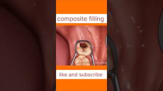 Animation composite filling process cavityfilling localdentistry youtubeshorts ytshortsindia [upl. by Lyrpa]