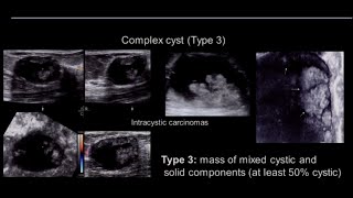 Breast Ultrasound Complicated Vs Complex Cyst [upl. by Enrobialc]