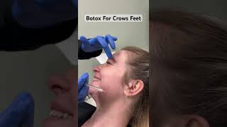 Botox For Crows Feet [upl. by Alo]