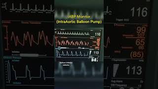 Intra Aortic Balloon Pump IABP cardiology [upl. by Alleunamme538]