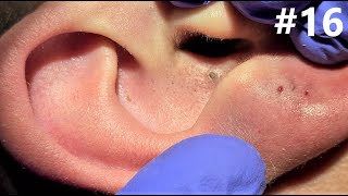 BLACKHEADS EXTRACTIONS on Happy 16 [upl. by Melita]