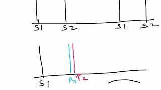 loud P2  component of the Second heart sound S2 [upl. by Pasahow]