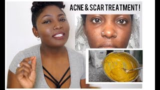 TURMERIC FACE MASK DID THIS IN JUST 7 DAYS  DIY TREATMENT FOR SCARS AND ACNE 2018 [upl. by Neeluj]