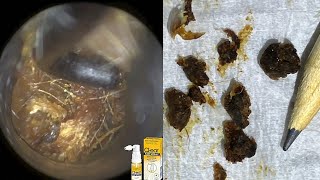 86  Completely Blocked amp Impacted Ear Wax Removal with WAXscope®️ [upl. by Nyved]