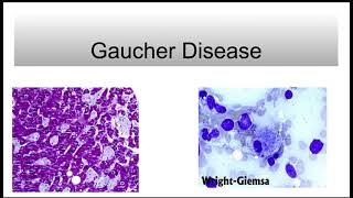 Gaucher Disease [upl. by Ahsinroc]