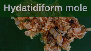 Complete Hydatidiform Mole  Pathology mini tutorial [upl. by Nandor]