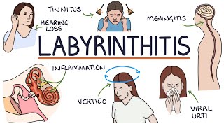 Understanding Labyrinthitis [upl. by Moor]