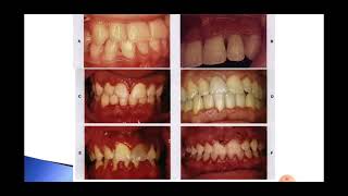 Intraoral Examination Part IV [upl. by Burke715]