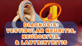 DIAGNOSIS Vestibular Neuritis Neuronitis amp Labyrinthitis  Dizzy Therapy [upl. by Kreindler]