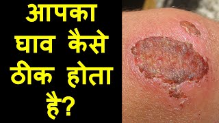 Wound Healing How does it happen  Hindi  Priyank Singhvi [upl. by Ellennoj]