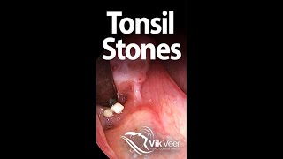 Tonsil stones forming in a large tonsil fissure [upl. by Redliw244]