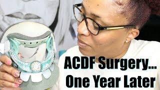 ACDF Surgery  One Year Later  Scar Photos [upl. by Glinys78]