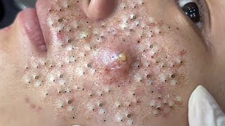 Big Cystic Acne Blackheads Extraction Blackheads amp Milia Whiteheads Removal Pimple Popping  171 [upl. by Aizirtap]