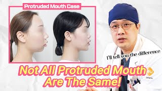 ENJPTH SUB Protruded Mouth Surgery Summarization  Not All Protruded Mouth Are The Same [upl. by Ku289]