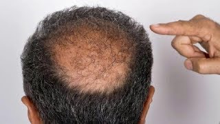 CURE BALDNESS And HOW TO REGROW HAIR NATURALLY without Transplant Surgery [upl. by Hollie184]