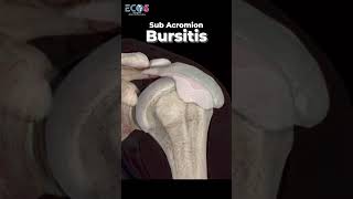 Sub Acromion Bursitis का दर्द  Dr Akash Agarwal viralvideo youtube [upl. by Khalil782]