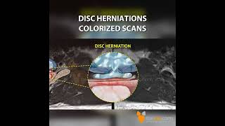 Disc Herniations Colorized Scans [upl. by Echikson795]