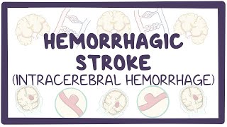 Hemorrhagic stroke intracerebral hemorrhage  causes symptoms diagnosis treatment pathology [upl. by Elac106]