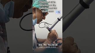 Nevus of OTA by Q Switched YAG Laser  Nevus of OTA Treatment in Delhi  Dr PK Talwar [upl. by Animrelliug]